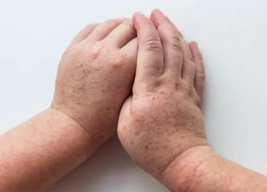 На Житомирі почастішали випадки захворюваності на скарлатину серед дітей