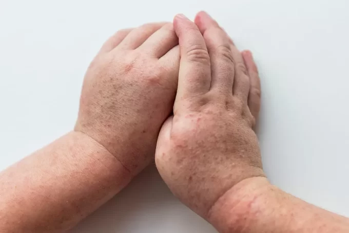 На Житомирі почастішали випадки захворюваності на скарлатину серед дітей