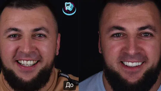 Причины популярности виниров