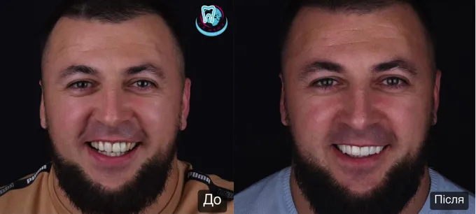 Причины популярности виниров