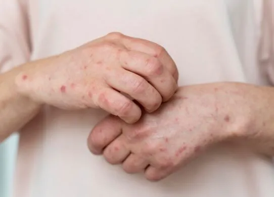 На Житомирщині двоє дітей захворіли на кір: медики пояснили, чому так сталося