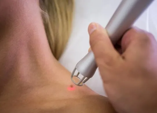 Видалення папілом: ефективні методи та поради для безпечної процедури