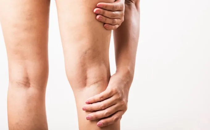 Когда лучше обращаться к флебологу клиники «Добробут» Когда лучше обращаться к флебологу клиники «Добробут»