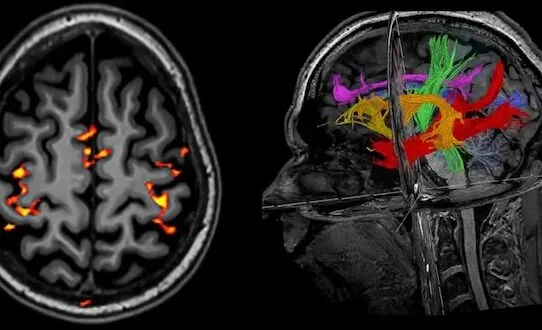 МРТ или КТ головы: что выбрать? Мнение нейрохирурга Наталии Скижи