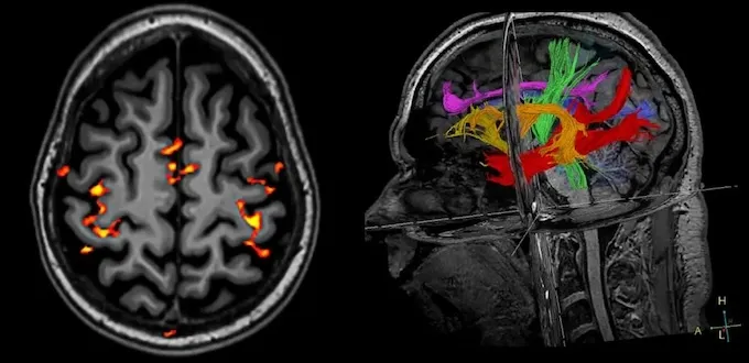 МРТ или КТ головы: что выбрать? Мнение нейрохирурга Наталии Скижи