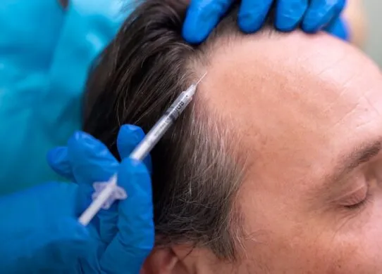 Поможет ли мезотерапия остановить выпадение волос раз и навсегда?