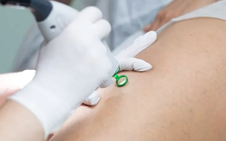 Видалення судинних "зірочок"